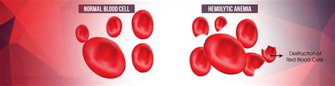 Hemolytic Anemia Causes Symptoms Diagnosis Treatment