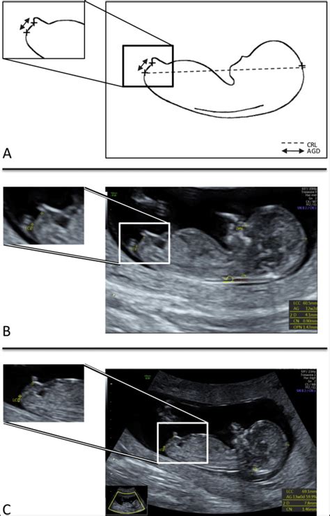 First Trimester Determination Of Fetal Gender By Ultrasound