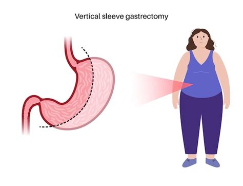 Premium Vector Vertical Sleeve Gastrectomy Laparoscopy Stomach