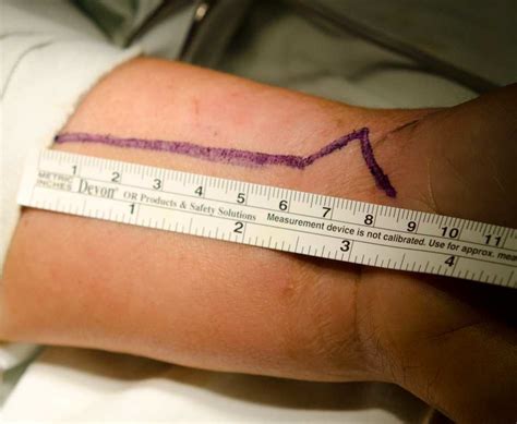 … this diagram with labels depicts and explains the. Skin incision over the FCR tendon and zigzag over the wrist flexion... | Download Scientific Diagram