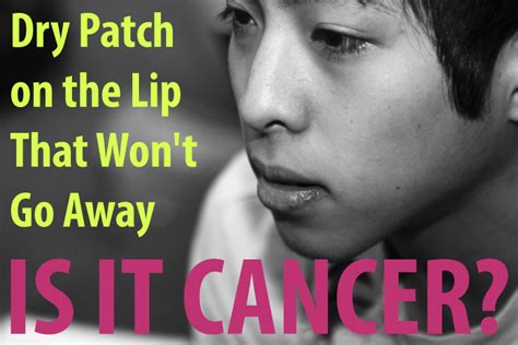 You'll find out what can increase your risk of getting this skin cancer at, basal cell carcinoma: Dry Patch on the Lip That Won't Go Away: Is It Lip Cancer ...