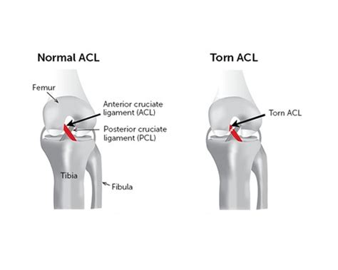 So What Is The Acl Fit2function Clinics