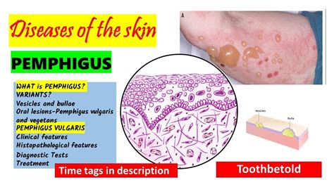 Pemphigus Vulgaris Pathogenesis Clinical Features Oral
