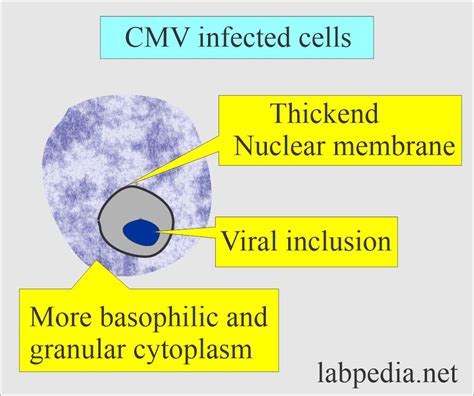Torch Profile Part 2 Cytomegalovirus Cmv