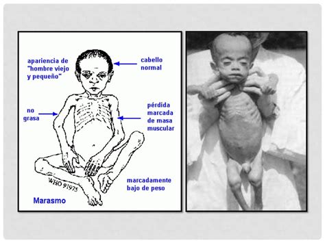Marasmo Y Kwashiorkor Pediatria