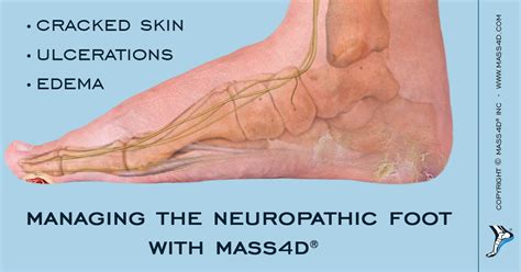 How To Manage The Neuropathic Foot With Mass4d® Mass4d® Foot Orthotics