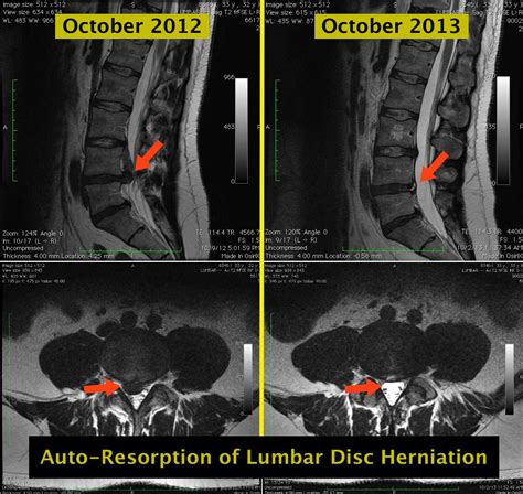 Mri Lss Auto Resorption Of Lumbar Disc Herniation Lumbar Disc Disk