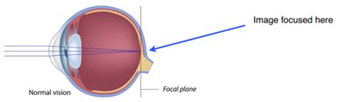 Myopia Shortsightedness Explanation