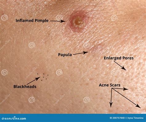 Inflamed Pimple On Nose Cyst Acne Acne On The Skin Royalty Free Stock