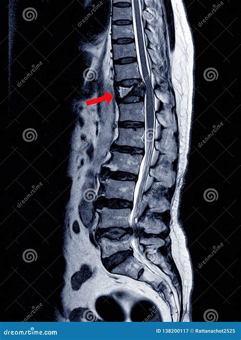 Mri Thoracic Lumbar Spine Show Moderate Pathological Compression
