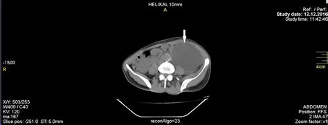 Postoperative Thoracoabdominal Computed Tomography Massive Chylous