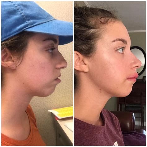 before after photos at about 2 weeks post op just had upper jaw surgery and am so far very