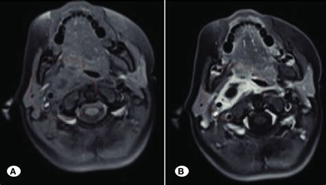 Pre A And Postcontrast B Axial Fat Saturated T1 Weighted Images