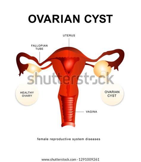 ovarian cyst female reproductive system diseases stock vector royalty free 1291009261