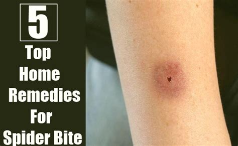 5 Home Remedies For A Spider Bite Search Herbal And Home Remedy