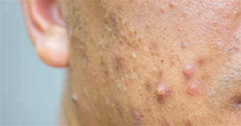 Understanding And Treating Nodular Acne Causes Identification And