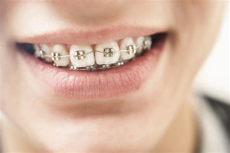 Braces to treat the tmd. What Age Do Kids Get Braces? How to Tell If Your Child ...