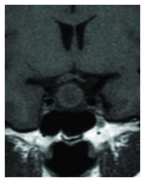 Figure 2 Diagnostic Significance Of Intracystic Nodules On Mri In