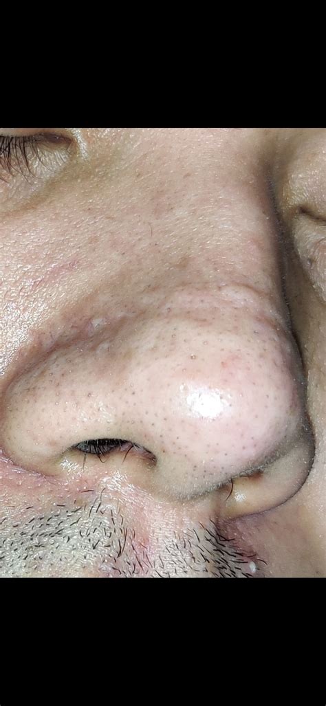 Severe Nose Scar Scar Treatments