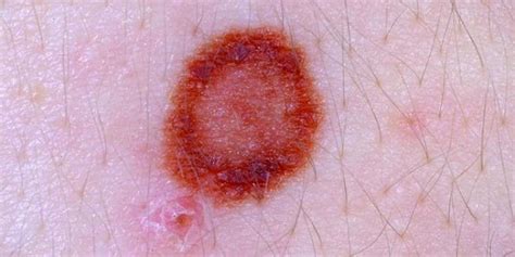 Must Watch Skin Cancer Photos To Identify It