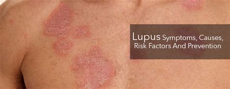 Lupus Symptoms Causes Risk Factors And Prevention