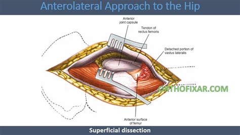 Anterolateral Approach To Hip Joint • Easy Explained • Orthofixar 2023