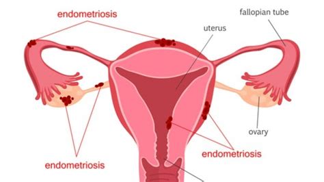 Endometriosis can affect women of any age. Der wahre Strippenzieher hinter Endometriose - Romina Scalco