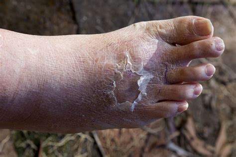 Cellulitis Symptoms Causes Pictures And Treatment