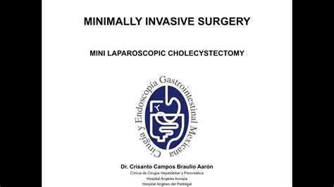 Mini Laparoscopic Cholecystectomy Youtube