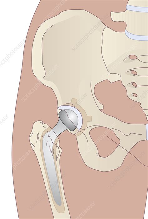 Hip Replacement Artwork Stock Image M600 0375 Science Photo Library