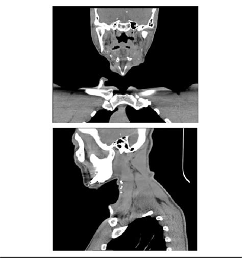 Figure 2 From Prominent Cervical Heterotopic Calcification Following
