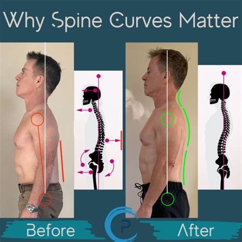 Why The Curve Of Our Spine Matters Pain Academy
