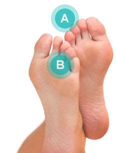 A bump on the bottom of the foot can be irritating or cause pain while walking. Morton's Neuroma: Symptoms, Causes, Treatment, and ...