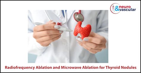 Radiofrequency Ablation And Microwave Ablation For Thyroid Nodules