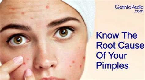 Know The Root Cause Of Your Pimples Getinfopedia
