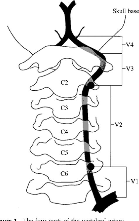 Figure From Diagnosis And Management Of Vertebral Artery Stenosis