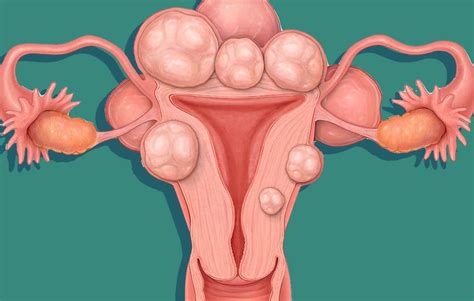 How To Shrink Uterine Fibroids Naturally Try These 5 Ways