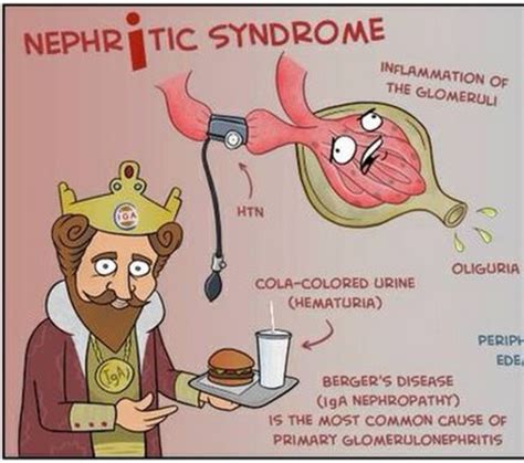 Exam 4 Glomerular Disease Nephriticnephrotic Syndrome Flashcards