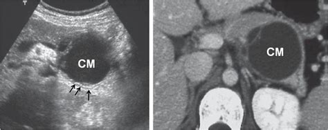 Il pancreas, infatti, è responsabile della secrezione di sostanze digestive che garantiscono, una sono la causa più frequente di pancreatite acuta. Le cisti e i tumori cistici del pancreas - Wirsung