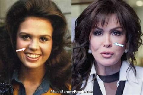 Did Marie Osmond Have Plastic Surgery Before And After Photos