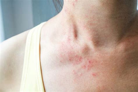 Hives And Angioedema Causes Diagnosis And Treatment