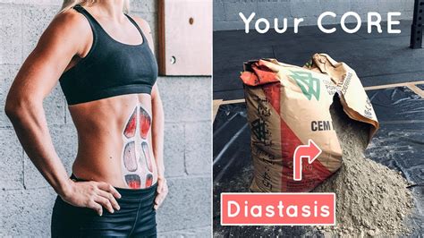 Mummy Tummy And Bloating Understand Your Core Diastasis Recti Youtube
