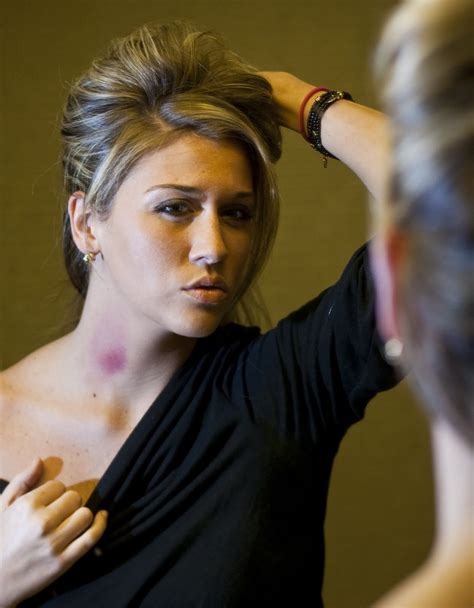 Belotero balance provides a natural correction thats uniquely you. How Long Does A Hickey Last For If Left Untreated?
