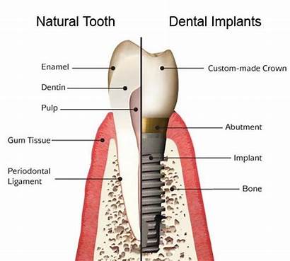 Dental Implant Implants Teeth Tooth Natural Dentist