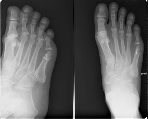 Hammertoe Correction Surgery In Nyc Downtown Podiatry Physicians