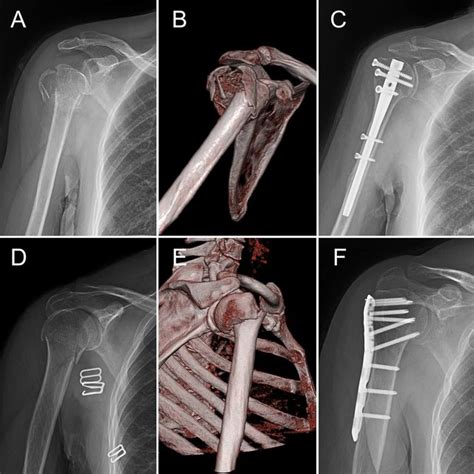 The Neer Classification For Proximal Humeral Fractures Modified Figure