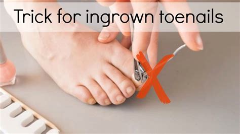 How To Fix Ingrown Toenails Easily Youtube