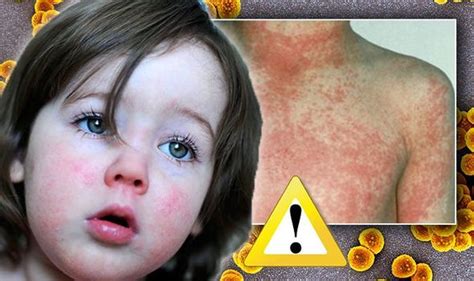 Scarlet Fever Outbreak Infection Cases Rise In Uk Symptoms And Signs Include Rash Uk