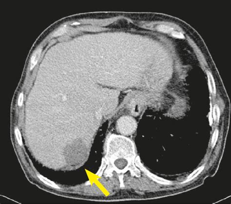 Ct Scan Of Hepatocellular Carcinoma In Right Lobe Of The Liver
