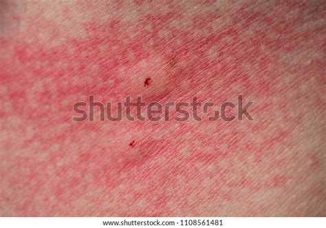 Bite Red Rash On Skin Close Stock Photo Edit Now 1108561481